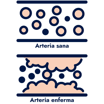 Arterias sanas y enfermas